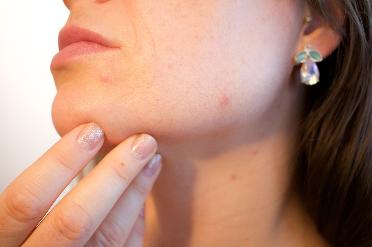 De beste huidverzorgingsproducten tegen acné
